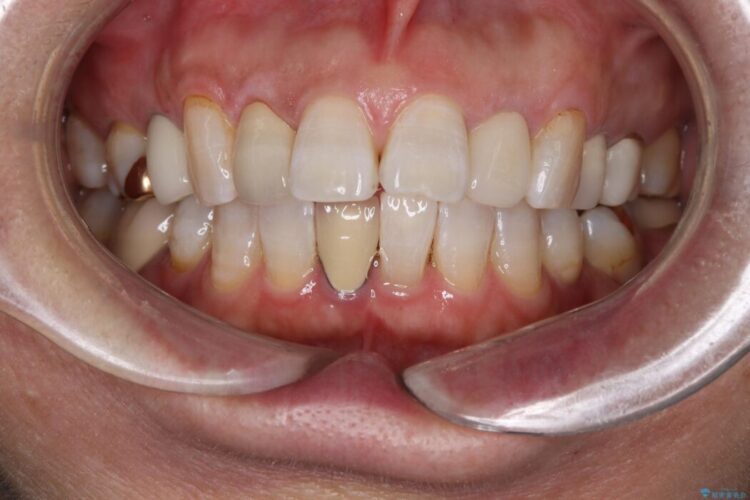 セラミックやり替え前のオフィスホワイトニング アフター