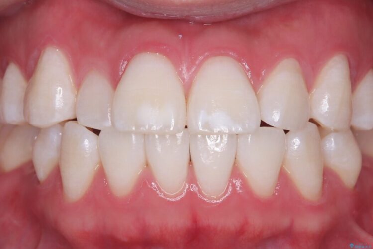 着色や黄ばみが気になる歯、オフィスホワイトニング アフター