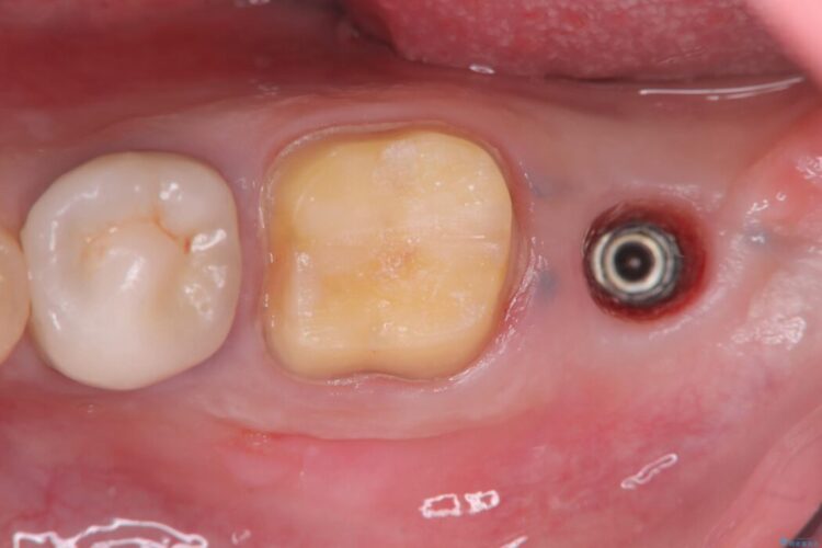1DAYインプラント|歯根嚢胞と瘻孔を伴う奥歯の治療 治療途中画像