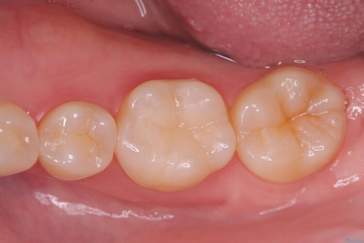 銀歯の段差の改善、ラバーダム防湿下で行うセラミックインレー治療 アフター