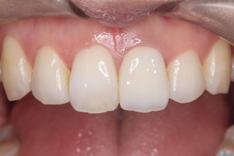 再根管治療とオールセラミックで前歯の気になる変色を解消 アフター