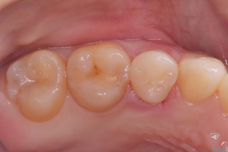 自然な見た目のセラミックインレーで精密に修復 アフター