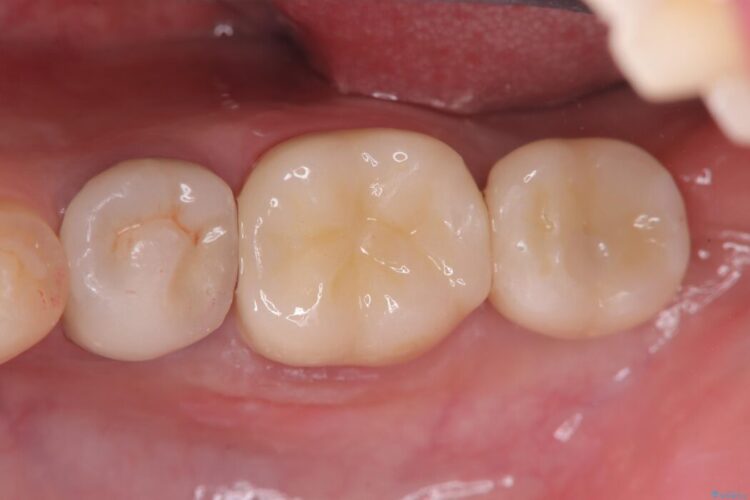 1DAYインプラント|歯根嚢胞と瘻孔を伴う奥歯の治療 アフター
