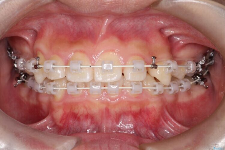 ガタつきとディープバイトの改善 治療途中画像