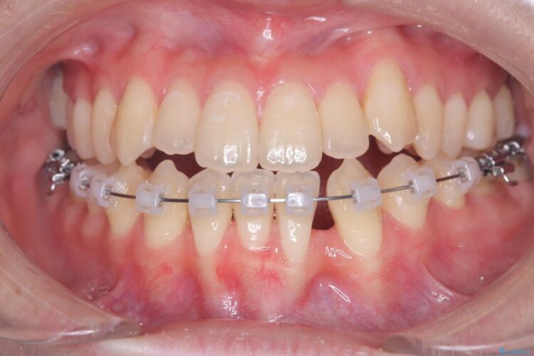 閉院による転院、インビザラインからワイヤー矯正への切り替え 治療途中画像