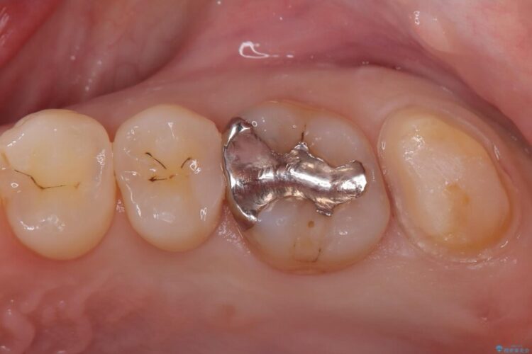 部分的断髄法（VPT）とセラミック修復 治療途中画像