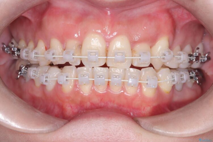 40代から始める矯正治療。八重歯が改善されすっきりとした歯並びに 治療途中画像