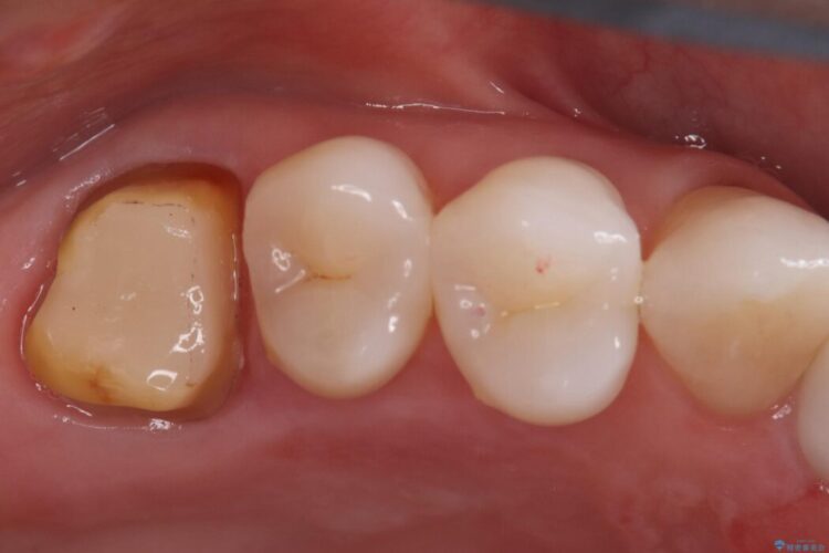 詰め物内部の虫歯治療、隠れた根管の発見 治療途中画像