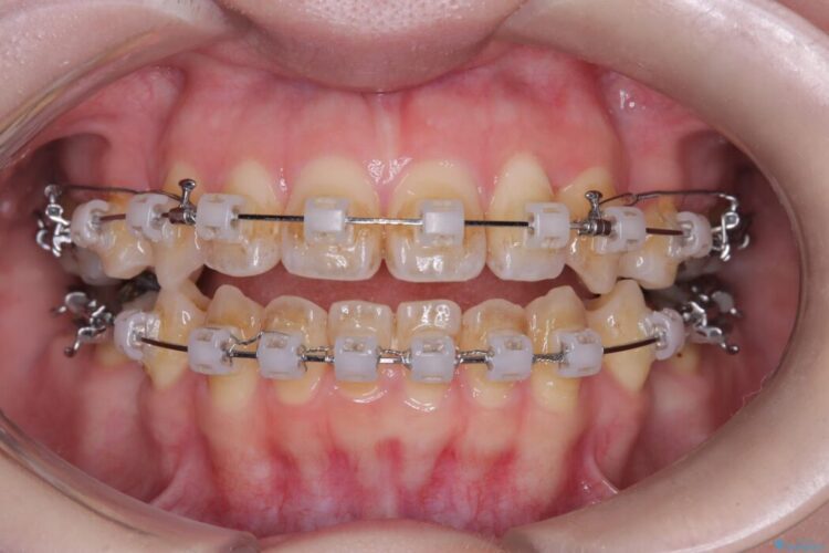 開咬・叢生・八重歯を抜歯矯正で改善 治療途中画像