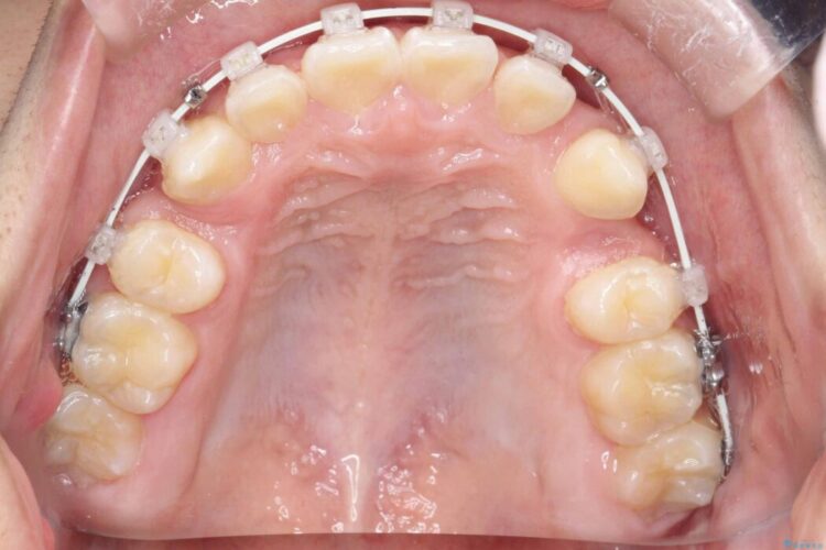 ガタつきとディープバイトの改善 治療途中画像