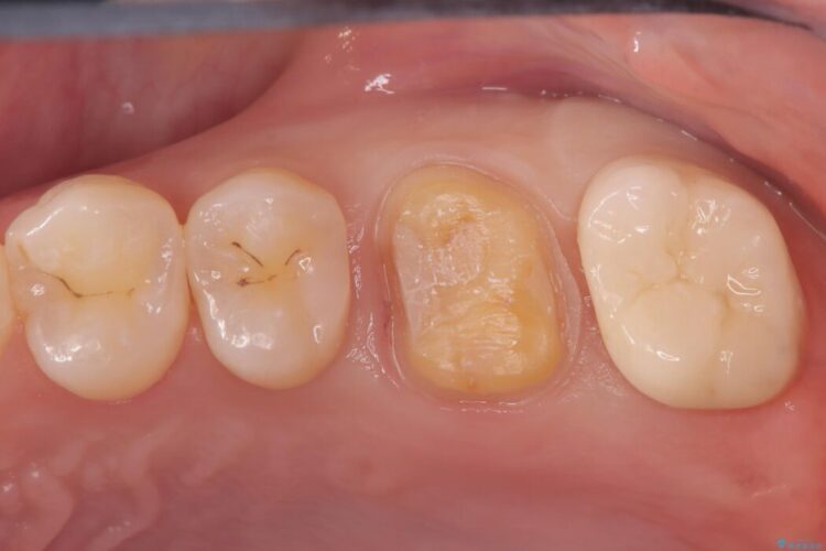 部分的断髄法（VPT）とセラミック修復 治療途中画像