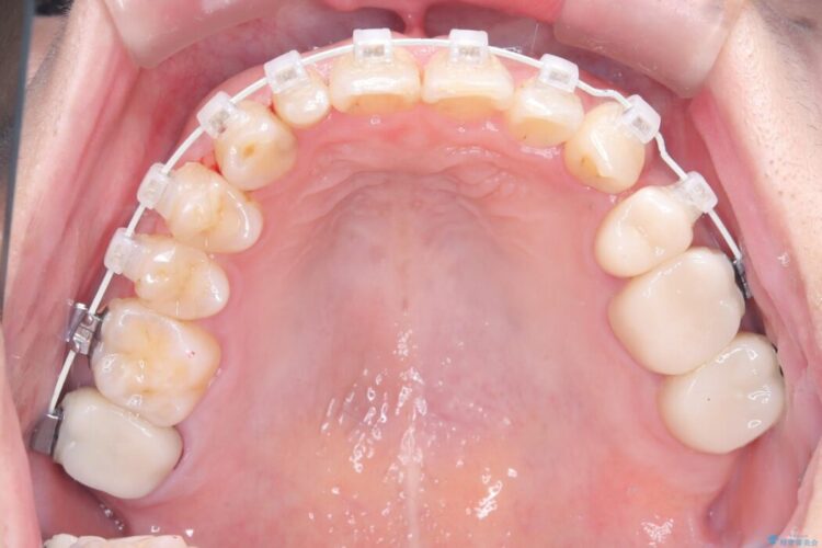 40代から始める矯正治療。八重歯が改善されすっきりとした歯並びに 治療途中画像