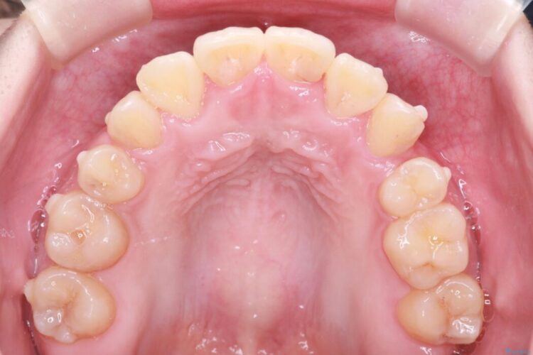 ワイヤー矯正とインビザラインの併用で重度のガタつきの改善 治療途中画像