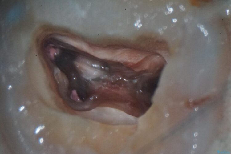 詰め物内部の虫歯治療、隠れた根管の発見 治療途中画像