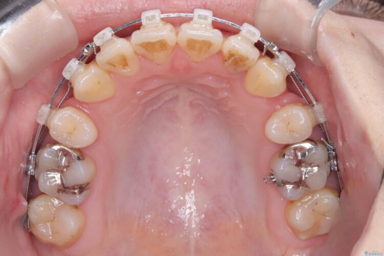 開咬・叢生・八重歯を抜歯矯正で改善 治療途中画像