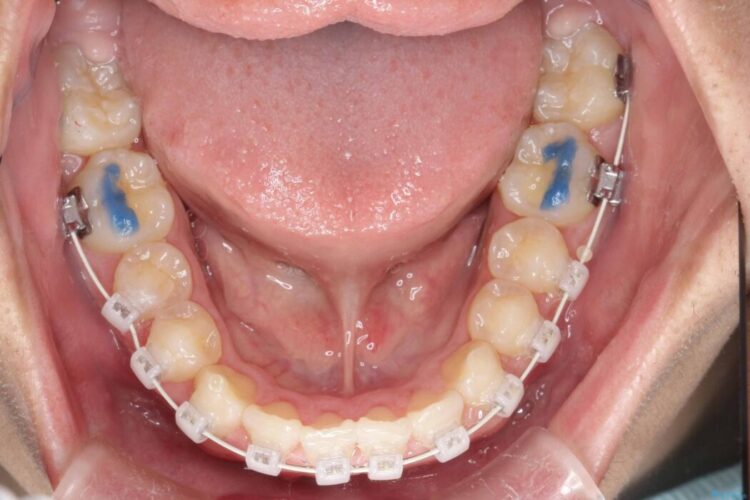 ガタつきとディープバイトの改善 治療途中画像