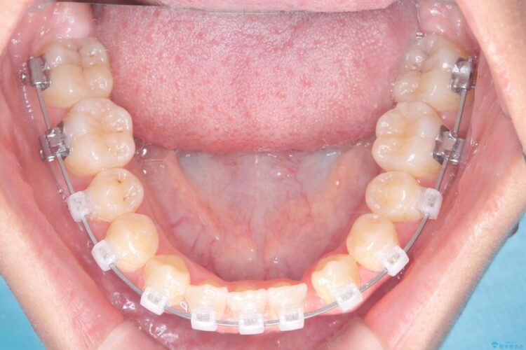 閉院による転院、インビザラインからワイヤー矯正への切り替え 治療途中画像