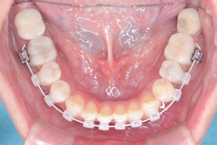 40代から始める矯正治療。八重歯が改善されすっきりとした歯並びに 治療途中画像