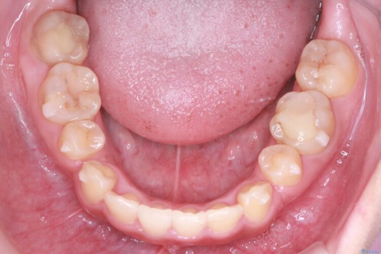 ワイヤー矯正とインビザラインの併用で重度のガタつきの改善 治療途中画像