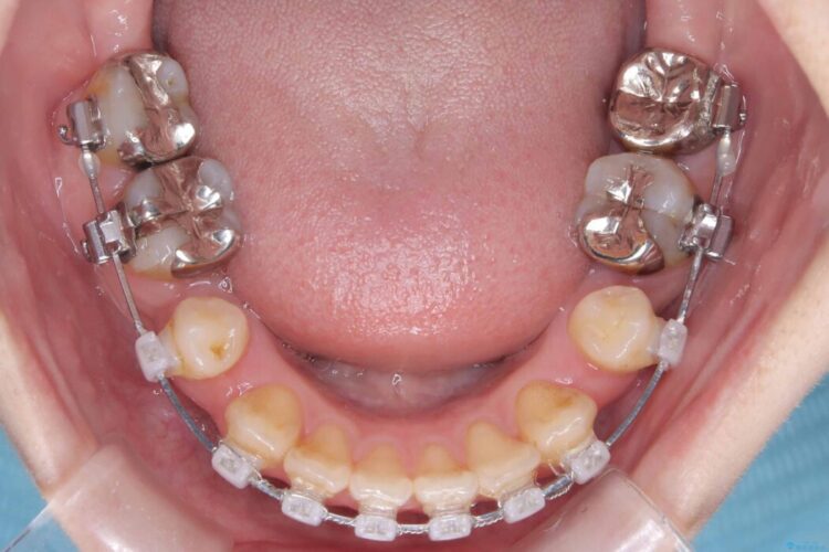 開咬・叢生・八重歯を抜歯矯正で改善 治療途中画像