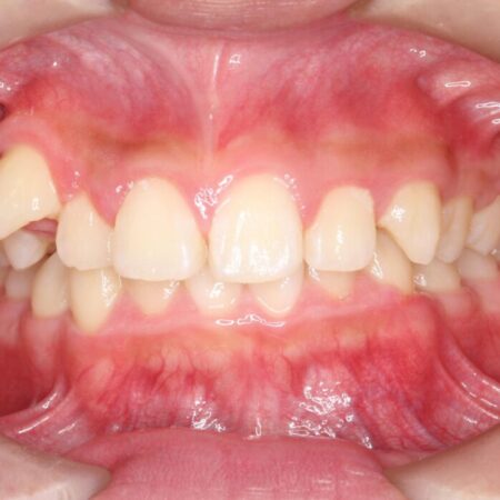 ガタつきとディープバイトの改善 治療前
