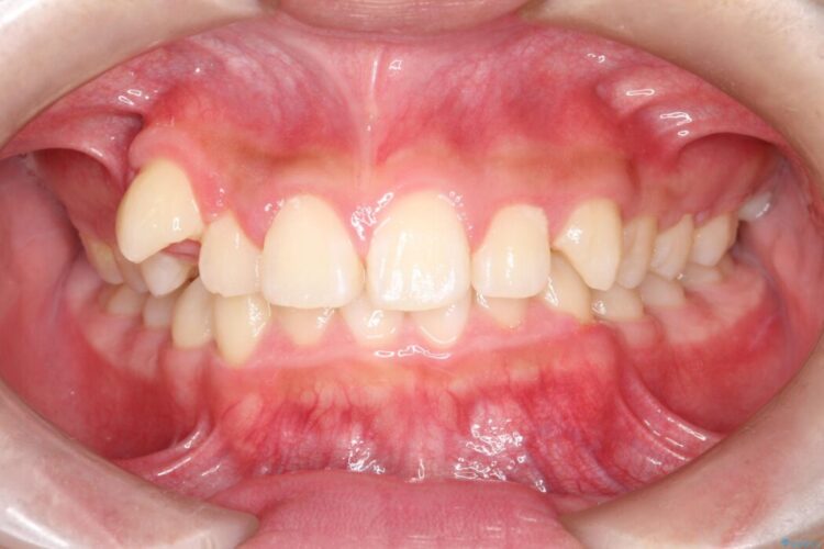 ガタつきとディープバイトの改善 ビフォー