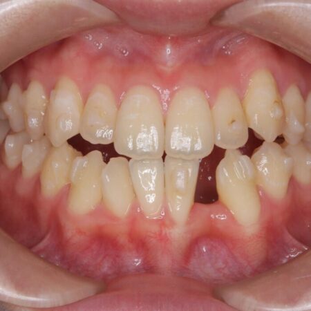 閉院による転院、インビザラインからワイヤー矯正への切り替え 治療前