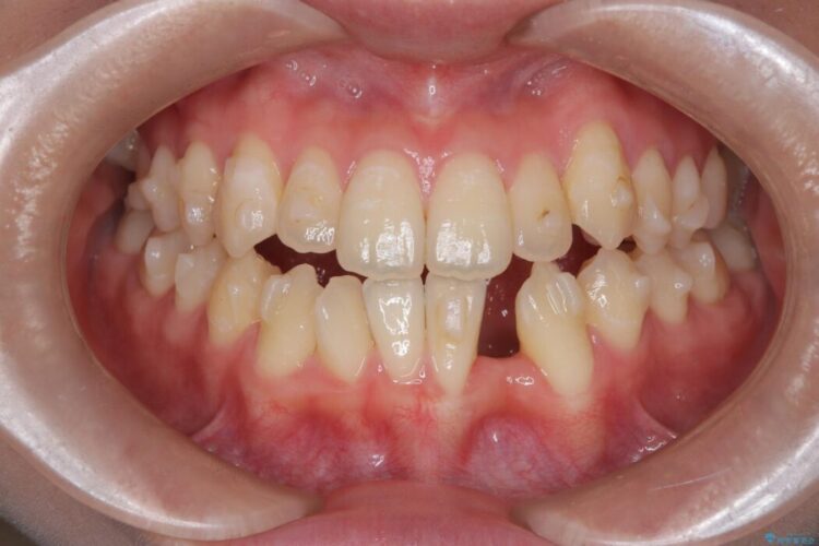 閉院による転院、インビザラインからワイヤー矯正への切り替え ビフォー