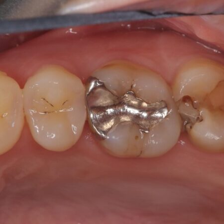 部分的断髄法（VPT）とセラミック修復 治療前