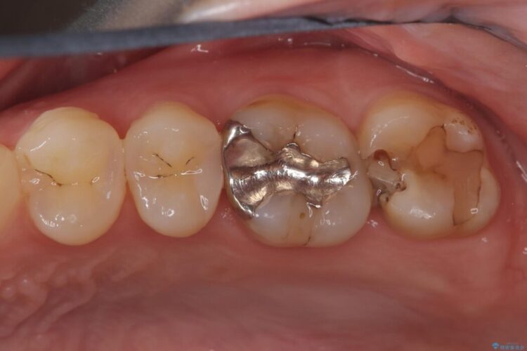 部分的断髄法（VPT）とセラミック修復 ビフォー