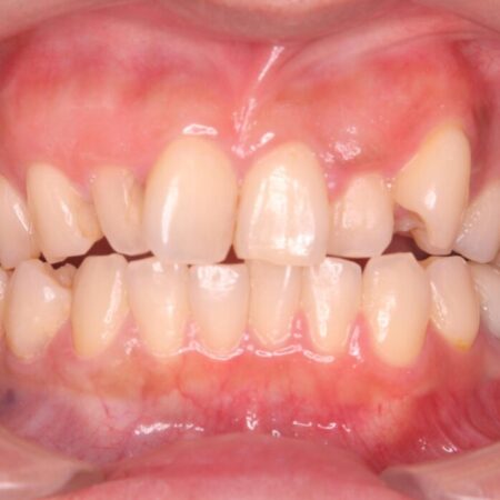 40代から始める矯正治療。八重歯が改善されすっきりとした歯並びに 治療前