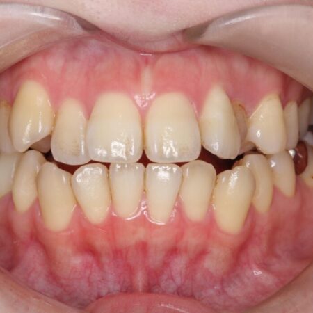 開咬・叢生・八重歯を抜歯矯正で改善 治療前