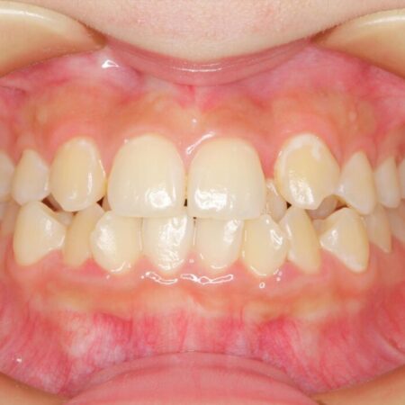 ワイヤー矯正とインビザラインの併用で重度のガタつきの改善 治療前