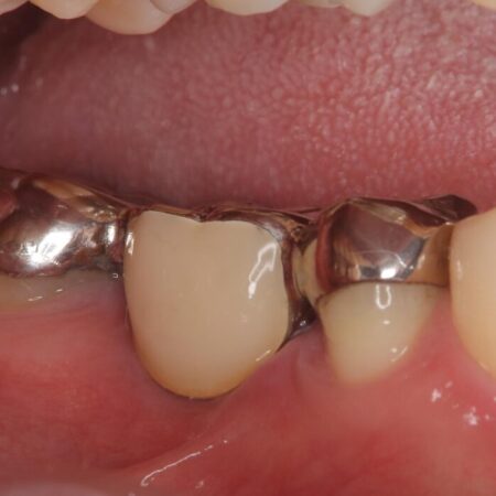 歯肉移植後、ブリッジからインプラントへ 治療前