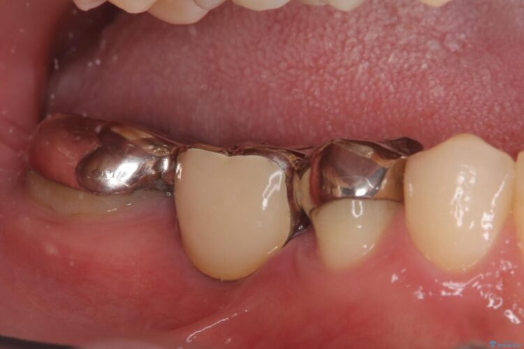 歯肉移植後、ブリッジからインプラントへ 治療前画像