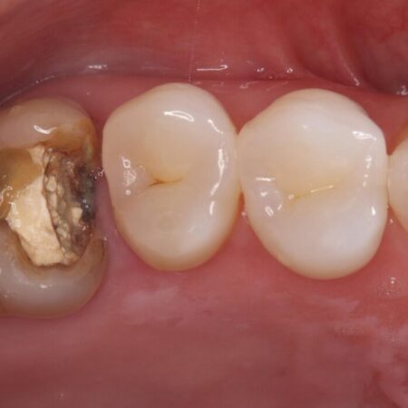 詰め物内部の虫歯治療、隠れた根管の発見 治療前