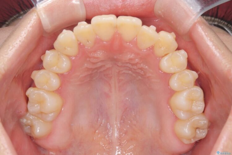 閉院による転院、インビザラインからワイヤー矯正への切り替え 治療前画像