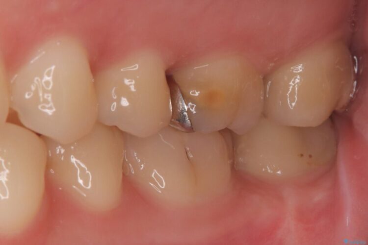 部分的断髄法（VPT）とセラミック修復 治療前画像