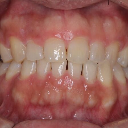 メタルフリー｜全ての銀歯をセラミックへ 治療前