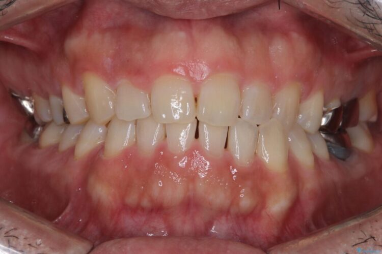 メタルフリー｜全ての銀歯をセラミックへ ビフォー