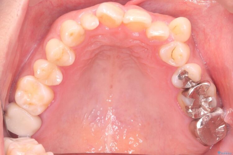 40代から始める矯正治療。八重歯が改善されすっきりとした歯並びに 治療前画像