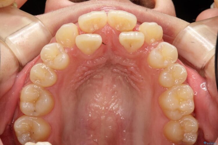 ワイヤー矯正とインビザラインの併用で重度のガタつきの改善 治療前画像