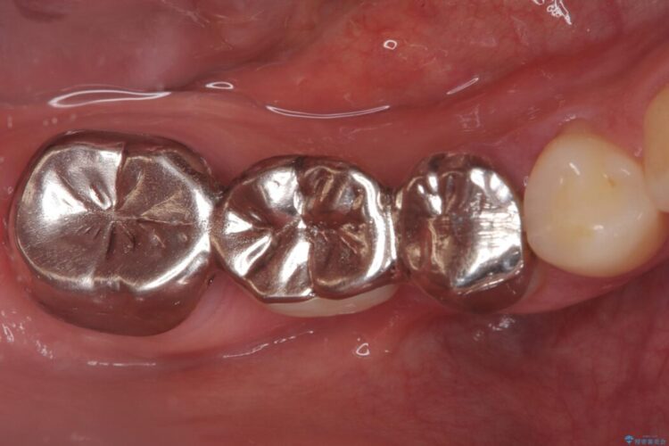 歯肉移植後、ブリッジからインプラントへ 治療前画像