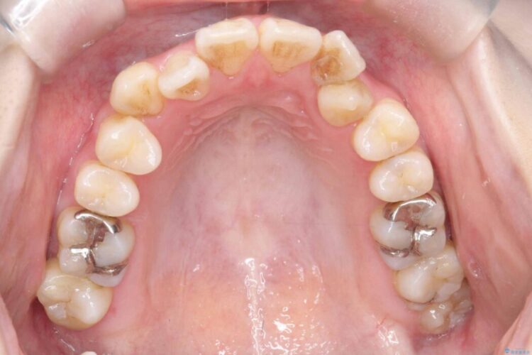 開咬・叢生・八重歯を抜歯矯正で改善 治療前画像