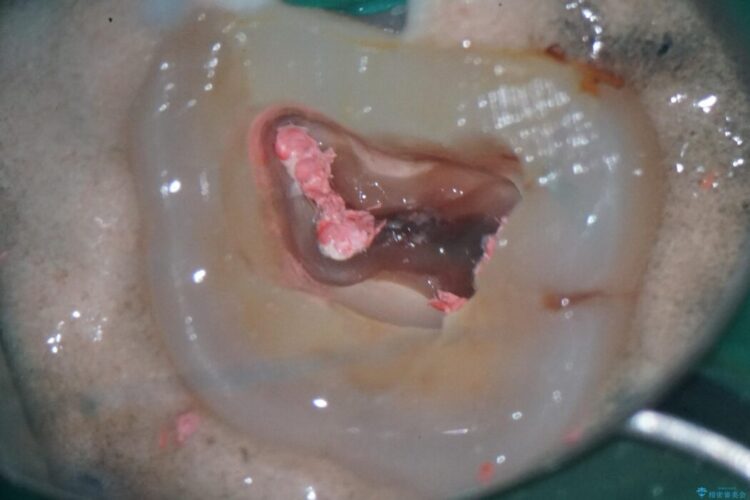 詰め物内部の虫歯治療、隠れた根管の発見 治療前画像