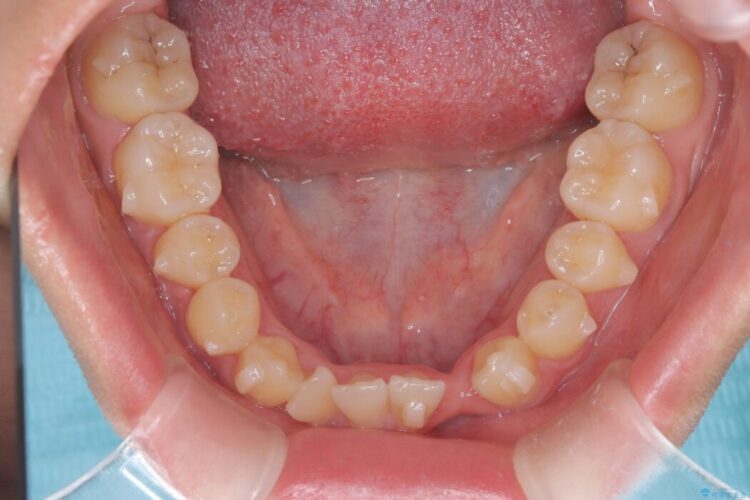 閉院による転院、インビザラインからワイヤー矯正への切り替え 治療前画像