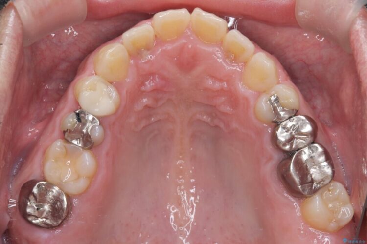 メタルフリー｜全ての銀歯をセラミックへ 治療前画像