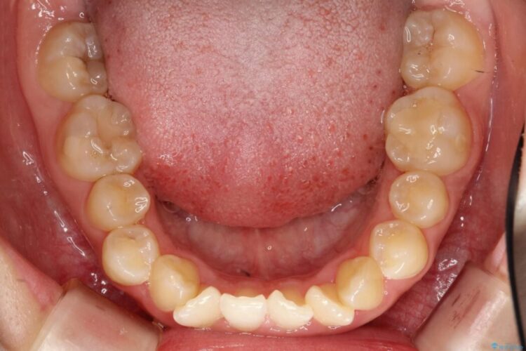 ワイヤー矯正とインビザラインの併用で重度のガタつきの改善 治療前画像