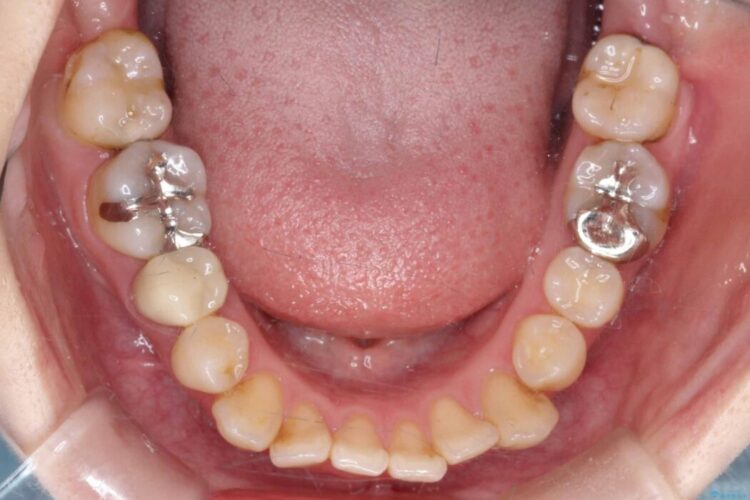 開咬・叢生・八重歯を抜歯矯正で改善 治療前画像