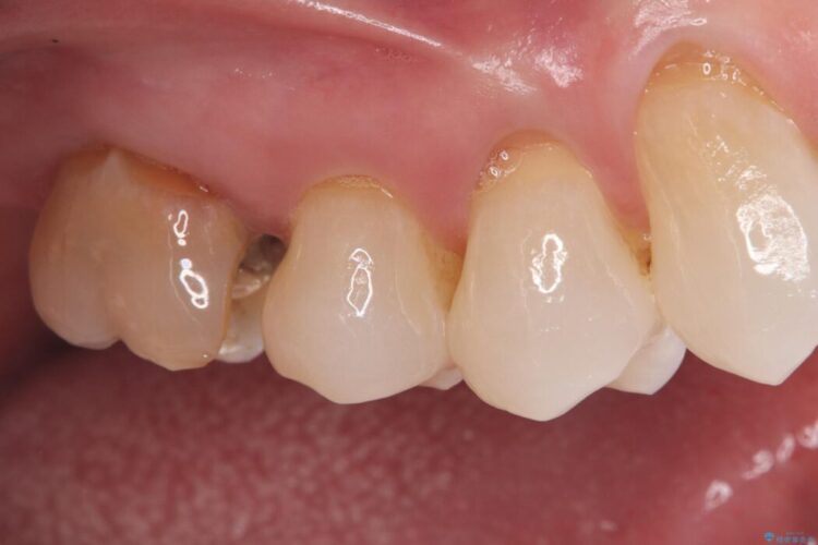 詰め物内部の虫歯治療、隠れた根管の発見 治療前画像